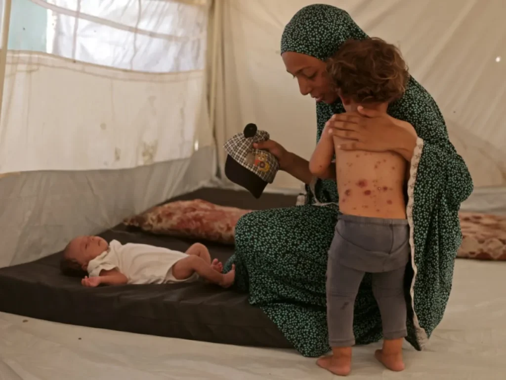خيام النازحين في غزة تتحول إلى بؤر عدوى