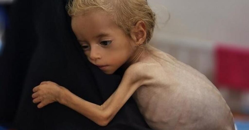 مسؤول طبي : نحو 1.6 مليون شخص مهددون بالمجاعة وسوء التغذية بغزة